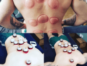 Does Wet Cupping Work? or is it just a load of Hocus Pocus!